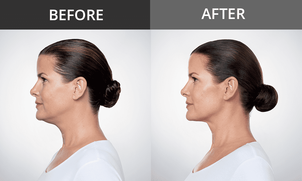 Best Chin fat removal