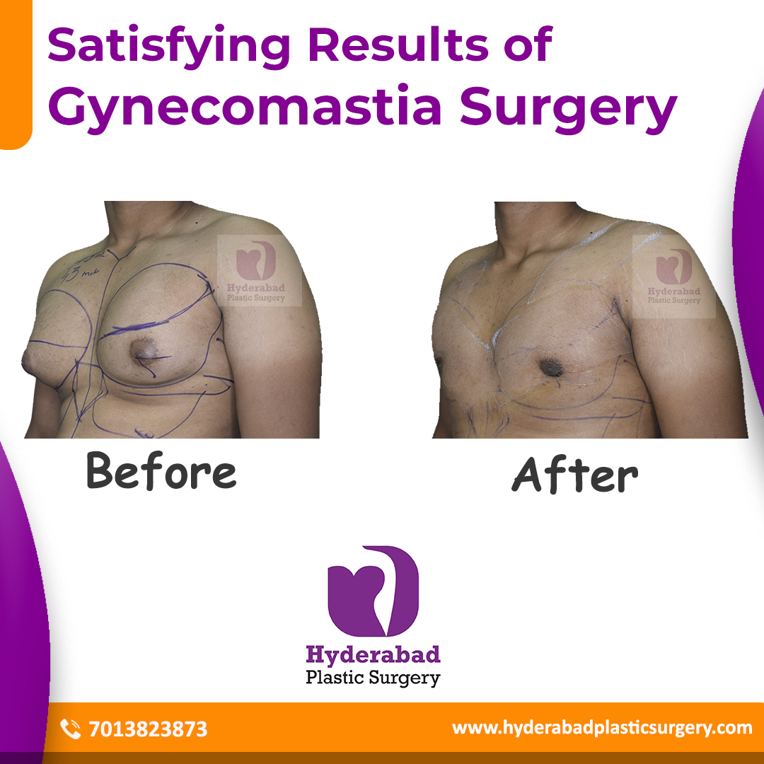 Best gynecomastia surgery in hyderabad