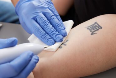 Laser Tattoo Removal Cost in Dubai